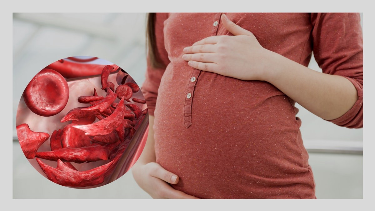 Bệnh hồng cầu hình liềm ảnh hưởng đến thai kì